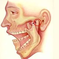 Temporo-Mandibular Joint (TMJ) Disorder
