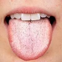 dental health-oral thrush