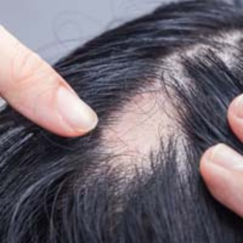 Alopecia