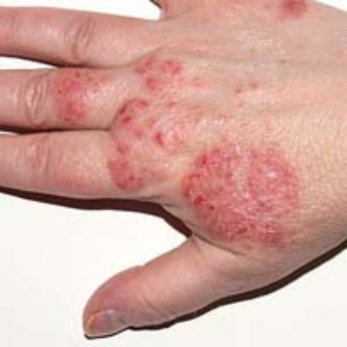 Eczema