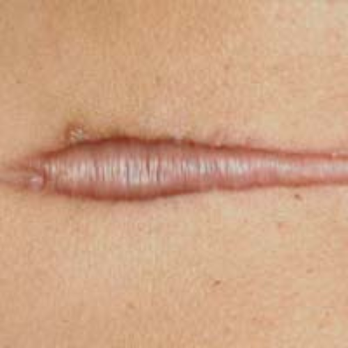 Keloid