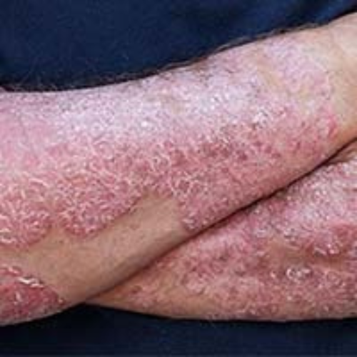 Psoriasis