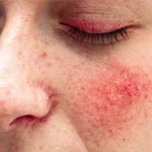 Rosacea