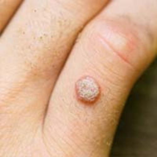 Warts