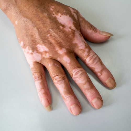 Vitiligo