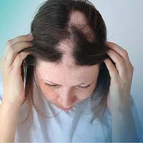 ALOPECIA in women, solution by the labon. only compounding pharmacy in Pakistan
