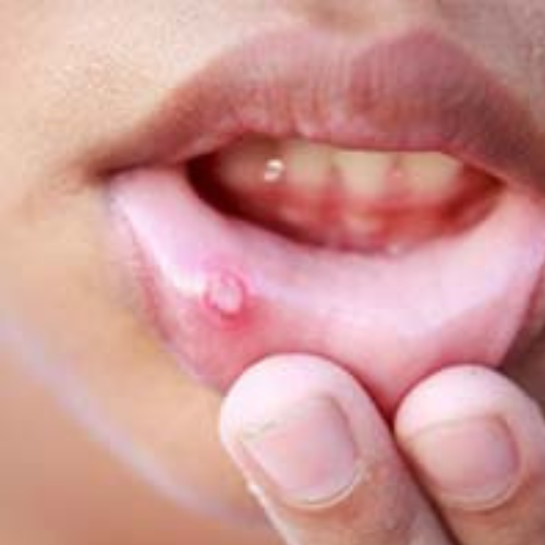 Aphthous Ulcers, Canker Sores, & Oral Lesions cure by the labon compounding pharmacy