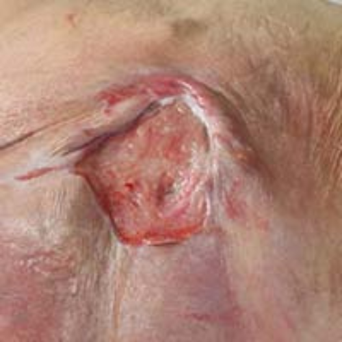 bed sore treatment