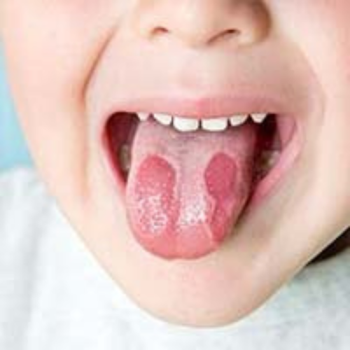 BURNING MOUTH in cancer patients is cured by the Labon compounding pharmacy in Pakistan