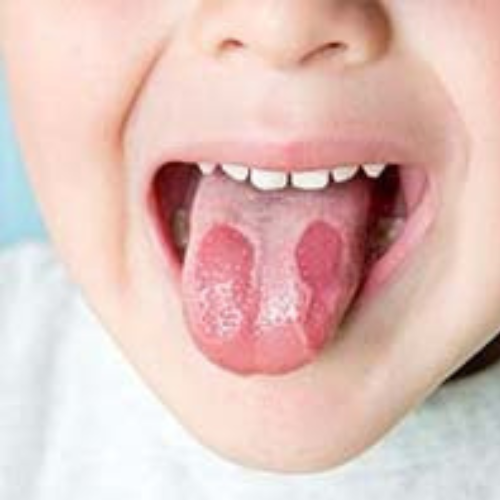 Burning Mouth Syndrome remedy by the labon