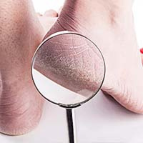 CRACKED HEEL solution by theLabon: A registred compounding pharmacy in Pakistan
