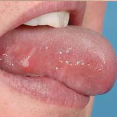 Dry Mouth, Mucositis and Stomatitis cure by the Labon