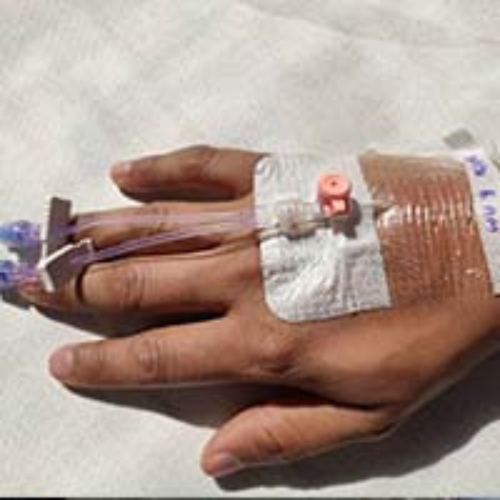 EXTRAVASATION in cancer patients is very common it is being successfully cured by the Labon compounding pharmacy in Pakistan