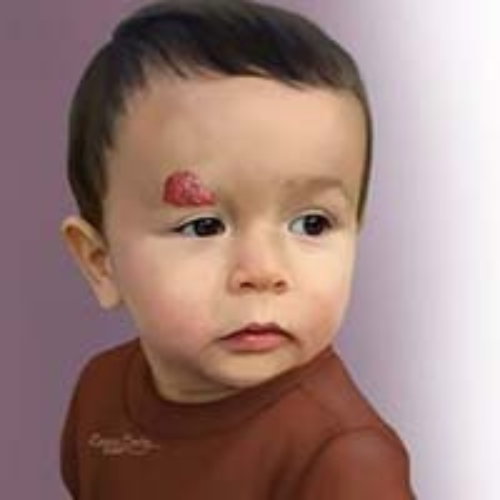 Cure HEMANGIOMA with theLAbon compounding pharmacy's products.