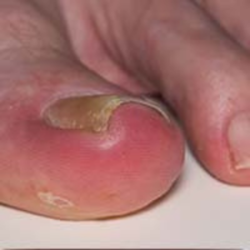 Cure INGROWN TOE NAIL by theLabon compounding customized specially for the particular condition. theLabon is a registered compounding Pharmacy in Pakistan