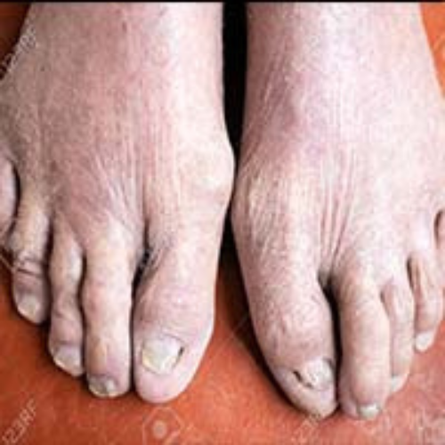 ITCHING FEET treatment