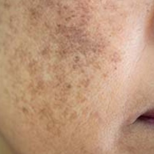 Melasma solution by the Labon. A GMP certified compounding pharmacy in Pakistan