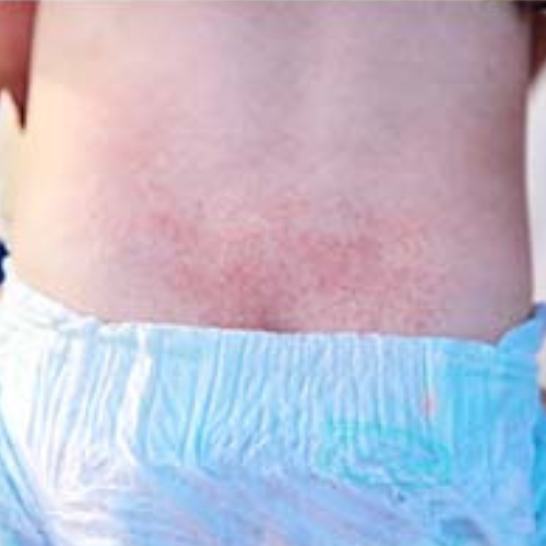 Nappy Rash by the labon.