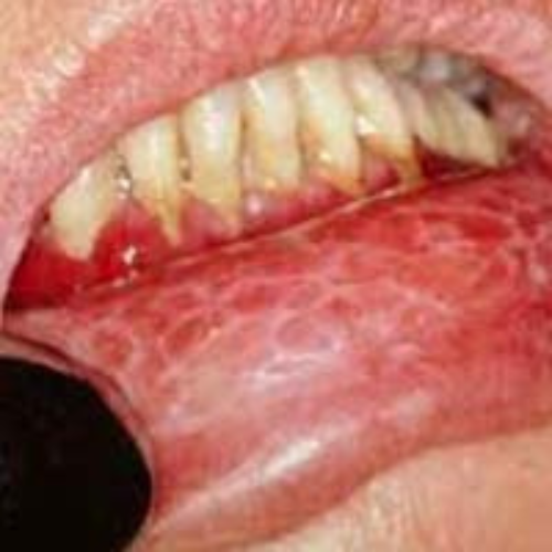 Oral Lichen Planus remedy by the Labon