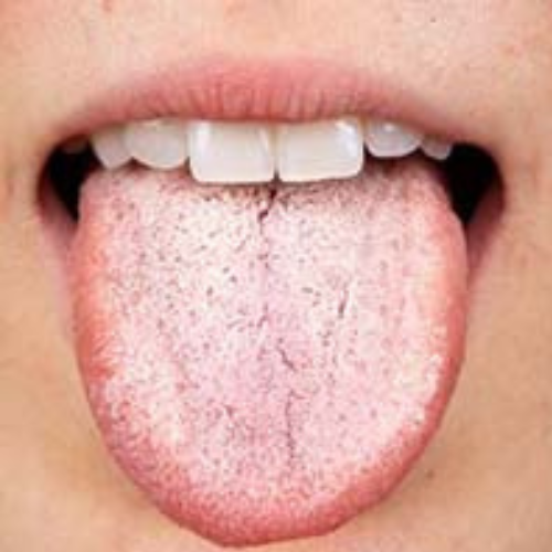oral thrush remedy by the labon