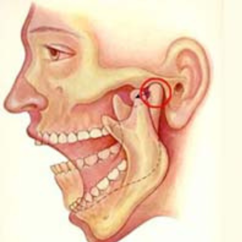 Temporo-Mandibular Joint (TMJ) Disorder remedy
