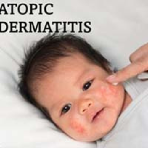 Atopic-Dermatitis solutions by theLabon