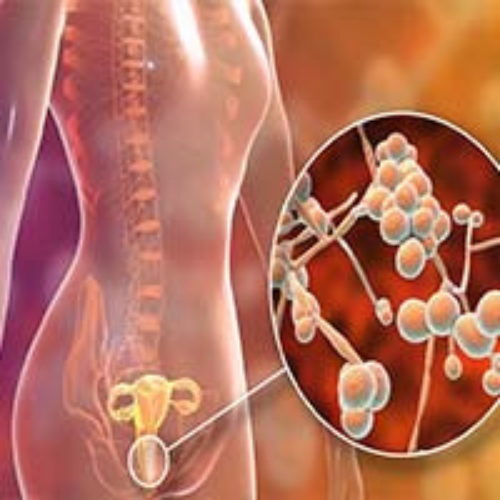 Yeast infection solutions by thelabon. A GMP certified compounding pharmacy in Pakistan.