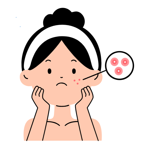 Acne Causes and Treatment